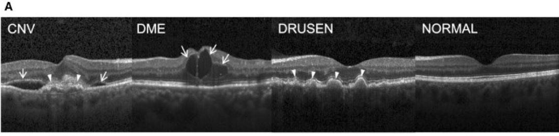 images of lung growths categorized by presence and type of malignancy